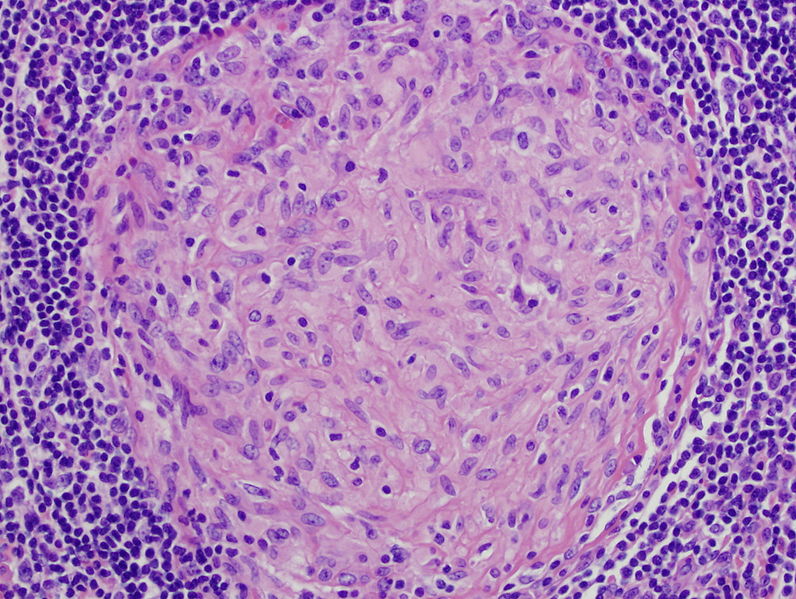 complement-system-granuloma-exudate-vs-transudate-stomp-on-step1